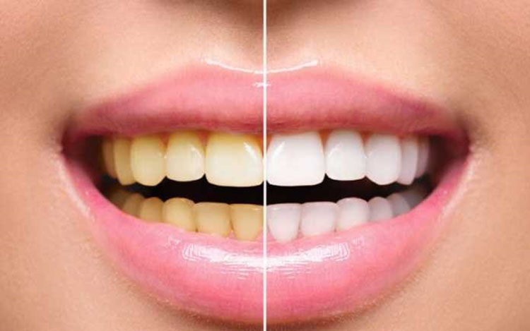 هفت راه ساده برای سفید کردن طبیعی دندان