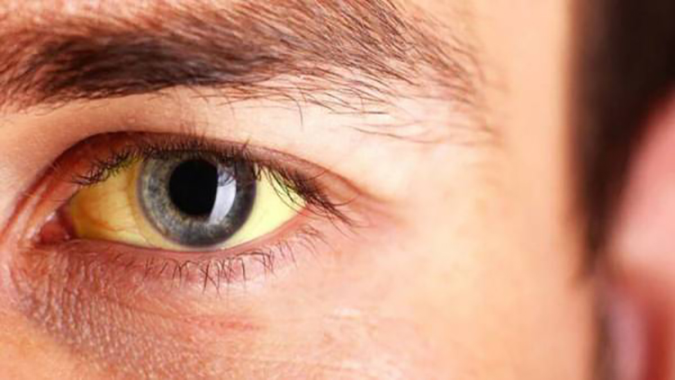 علل زردی چشم و درمان آن
