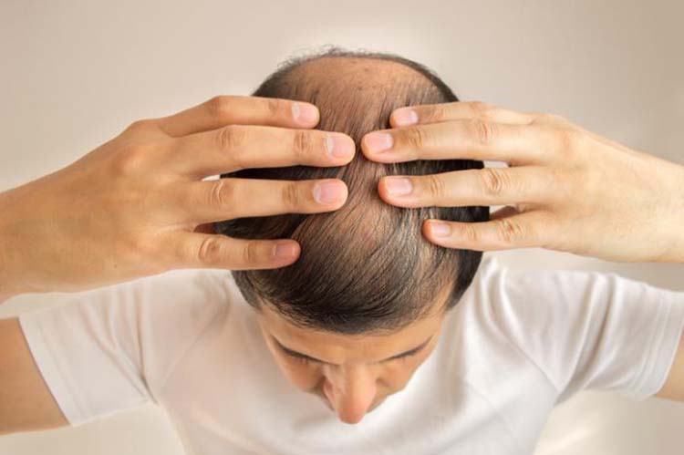 علل ریزش مو و درمان آن در آقایان