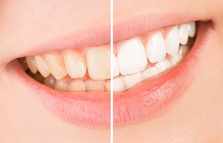 چه عواملی باعث زردی دندان می شود؟